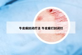 牛皮癬封閉療法 牛皮廨打封閉針