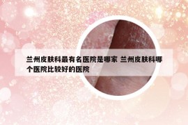 蘭州皮膚科最有名醫(yī)院是哪家 蘭州皮膚科哪個醫(yī)院比較好的醫(yī)院