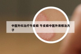 中醫(yī)外科治療牛皮癬 牛皮癬中醫(yī)外用根治方子