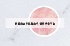銀屑病會導致貧血嗎 銀屑病會不會