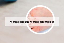 寧波銀屑病哪家好 寧波銀屑病醫(yī)院哪里好