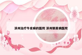 濱州治療牛皮癬的醫(yī)院 濱州銀屑病醫(yī)院