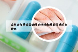 吃魚會(huì)加重銀屑病嗎 吃魚會(huì)加重銀屑病嗎為什么