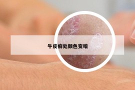 牛皮癬處顏色變暗