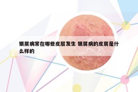 銀屑病常在哪些皮層發(fā)生 銀屑病的皮屑是什么樣的
