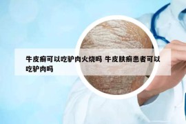 牛皮癬可以吃驢肉火燒嗎 牛皮膚癬患者可以吃驢肉嗎
