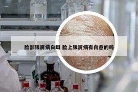臉部銀屑病白斑 臉上銀屑病有自愈的嗎