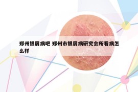 鄭州銀屑病吧 鄭州市銀屑病研究會(huì)所看病怎么樣