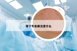 得了牛皮癬注意什么