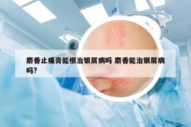 麝香止痛膏能根治銀屑病嗎 麝香能治銀屑病嗎?