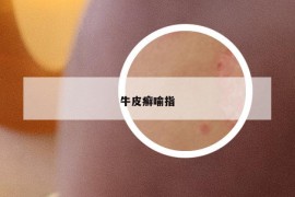 牛皮癬喻指