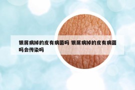銀屑病掉的皮有病菌嗎 銀屑病掉的皮有病菌嗎會(huì)傳染嗎