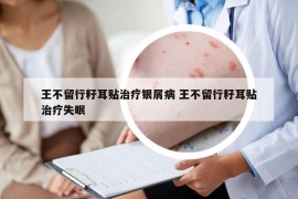 王不留行籽耳貼治療銀屑病 王不留行籽耳貼治療失眠