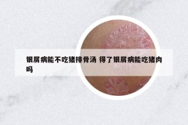 銀屑病能不吃豬排骨湯 得了銀屑病能吃豬肉嗎