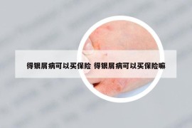 得銀屑病可以買保險(xiǎn) 得銀屑病可以買保險(xiǎn)嘛