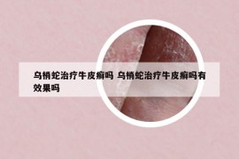 烏梢蛇治療牛皮癬嗎 烏梢蛇治療牛皮癬嗎有效果嗎