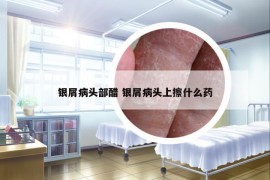銀屑病頭部醋 銀屑病頭上擦什么藥