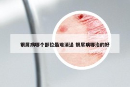 銀屑病哪個部位最難消退 銀屑病哪治的好