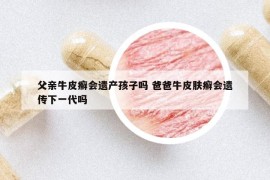 父親牛皮癬會(huì)遺產(chǎn)孩子嗎 爸爸牛皮膚癬會(huì)遺傳下一代嗎