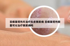 百癬夏塔熱片治療頭皮銀屑病 百癬夏塔熱膠囊可以治療銀屑病嗎