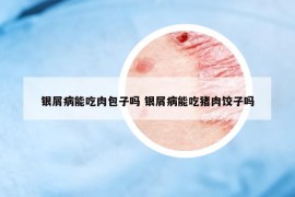 銀屑病能吃肉包子嗎 銀屑病能吃豬肉餃子嗎
