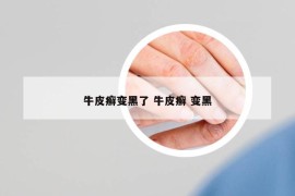 牛皮癬變黑了 牛皮癬 變黑
