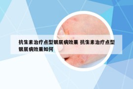抗生素治療點(diǎn)型銀屑病效果 抗生素治療點(diǎn)型銀屑病效果如何