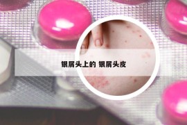 銀屑頭上的 銀屑頭皮