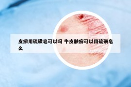 皮癬用硫磺皂可以嗎 牛皮膚癬可以用硫磺皂么