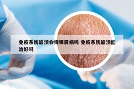 免疫系統(tǒng)崩潰會(huì)得銀屑病嗎 免疫系統(tǒng)崩潰能治好嗎