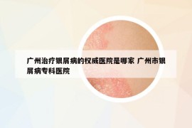 廣州治療銀屑病的權(quán)威醫(yī)院是哪家 廣州市銀屑病?？漆t(yī)院