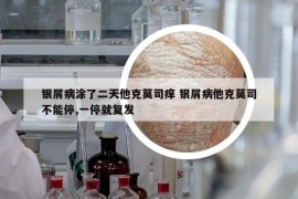 銀屑病涂了二天他克莫司癢 銀屑病他克莫司不能停,一停就復(fù)發(fā)