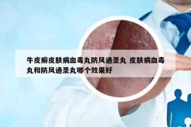 牛皮癬皮膚病血毒丸防風(fēng)通圣丸 皮膚病血毒丸和防風(fēng)通圣丸哪個效果好