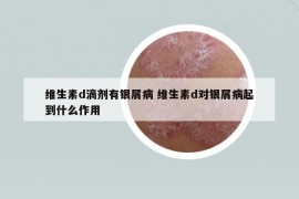 維生素d滴劑有銀屑病 維生素d對(duì)銀屑病起到什么作用