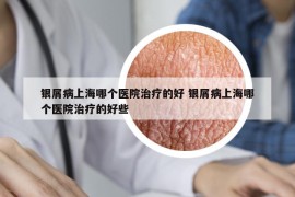 銀屑病上海哪個醫(yī)院治療的好 銀屑病上海哪個醫(yī)院治療的好些