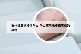 吉林銀屑病相信華山 華山醫(yī)院治療銀屑病的藥物
