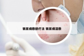 銀屑病敷臍療法 銀屑病濕敷