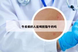 牛皮癬的人能喝脫脂牛奶嗎