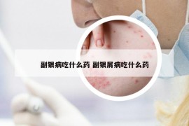 副銀病吃什么藥 副銀屑病吃什么藥