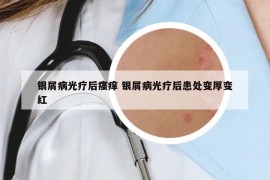 銀屑病光療后瘙癢 銀屑病光療后患處變厚變紅