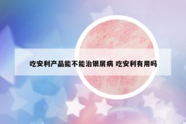 吃安利產(chǎn)品能不能治銀屑病 吃安利有用嗎