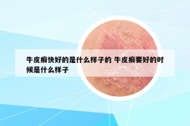 牛皮癬快好的是什么樣子的 牛皮癬要好的時候是什么樣子