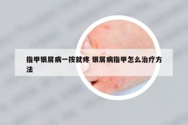 指甲銀屑病一按就疼 銀屑病指甲怎么治療方法