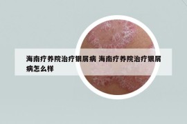 海南療養(yǎng)院治療銀屑病 海南療養(yǎng)院治療銀屑病怎么樣