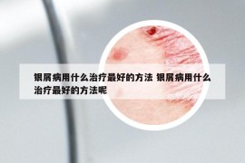 銀屑病用什么治療最好的方法 銀屑病用什么治療最好的方法呢