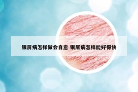 銀屑病怎樣做會(huì)自愈 銀屑病怎樣能好得快