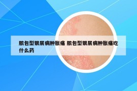 膿包型銀屑病腫脹痛 膿包型銀屑病腫脹痛吃什么藥