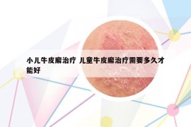 小兒牛皮廨治療 兒童牛皮廨治療需要多久才能好