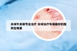 白城牛皮癬專業(yè)治療 白城治療布病最好的醫(yī)院在哪里