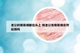 老公的銀屑病都在頭上 我老公有銀屑病會傳給我嗎